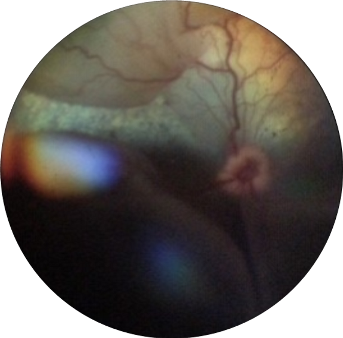 Retinal Detachment